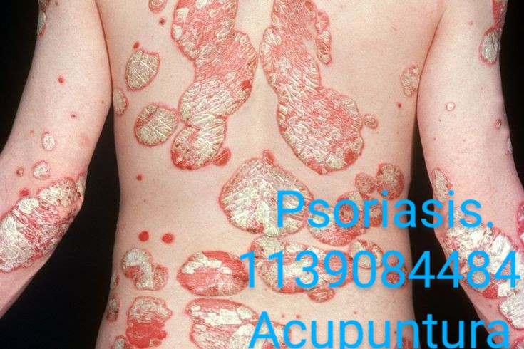 miedos fobias Dolor Zona Sur psoriasis ,Zona Sur Quilmes, Berazategui